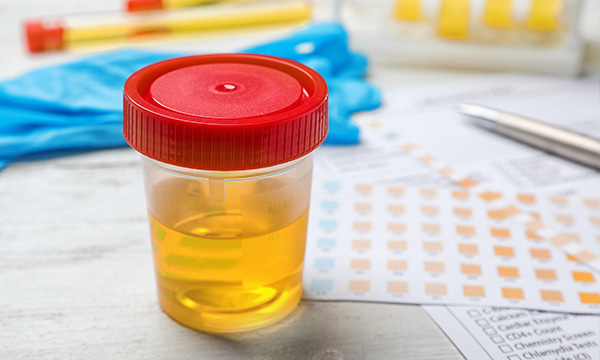 Исследование уровня йода в моче Исследование уровня йода в моче