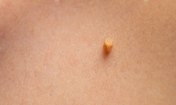 Удаление кондилом