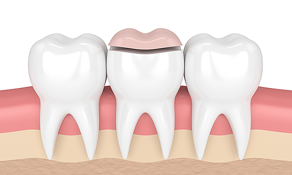 Временное пломбирование корневого канала