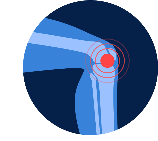 УЗИ коленного сустава